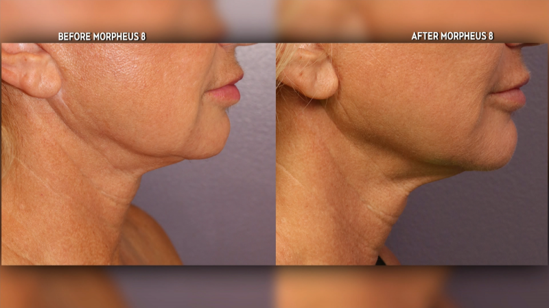 SPONSORED: Learn more about the skin tightening treatment options at Preventous Cosmetic Medicine
