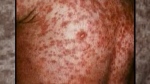 Warning about possible measles outbreaks