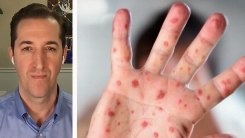 Ontario's top doctor is warning of the possibility of measles outbreaks in the province. Dr. Isaac Bogoch explains why.