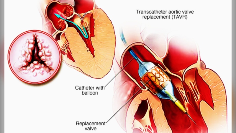 Dr. Dinar Shukla was the first in northern Ontario to do a procedure called transcatheter aortic valve implantation (TAVI). It’s a much less invasive procedure to replace the main artery to the heart after it has calcified or narrowed. (Mayo Clinic photo)