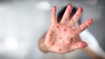 B.C. sees first measles case since 2019