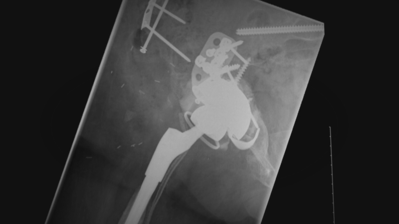 An X-ray of a joint replacement is shown. 