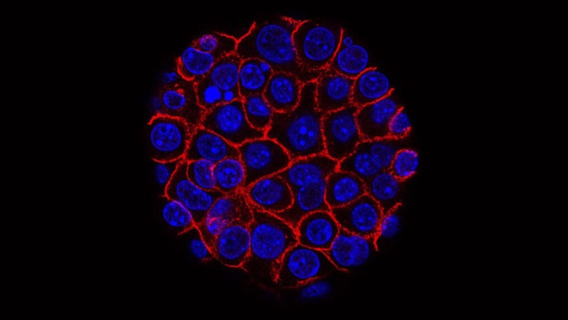 Pancreatic cancer cells, shown in blue, can be difficult to detect in early stages of the disease, and there is no single test that can tell you if you have pancreatic cancer early. (From the National Cancer Institute via CNN Newsource)