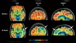These PET scan images provided by the New England Journal of Medicine in January 2024 show a reduction in amyloid-beta levels in an Alzheimer's patient. (New England Journal of Medicine via AP)