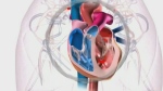 An animation displaying pulmonary hypertension.