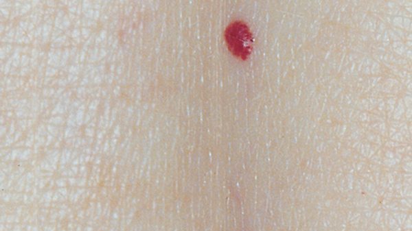 A small collection of blood vessels known as a cherry angioma appears as a red spot in this handout photo. (THE CANADIAN PRESS)