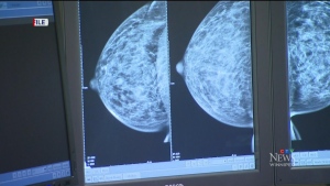 Improving the care for treating breast cancer

