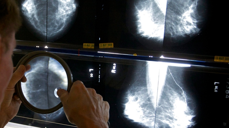 A radiologist uses a magnifying glass to check mammograms for breast cancer in Los Angeles, May 6, 2010. (THE CANADIAN PRESS/AP-Damian Dovarganes)