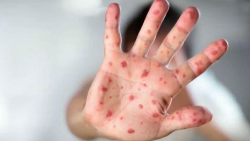Measles cases in Ontario highest in 10 years.
