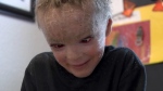 Nevada boy struggles with rare skin condition 