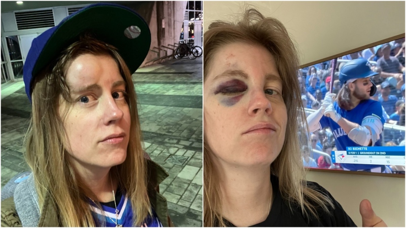 The Toronto Blue Jays will give tickets and a signed Bo Bichette baseball to Liz McGuire, who says she was hit in the face by a foul ball off the shortstop's bat. (X/Liz McGuire)