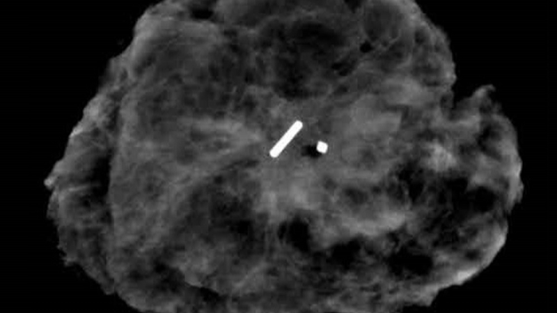 New procedure could help breast cancer treatment