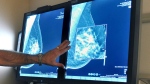 In this July 31, 2012 file photo, a radiologist compares an image from earlier, 2-D technology mammogram to the new 3-D Digital Breast Tomosynthesis mammography in Wichita Falls, Texas. (Torin Halsey/Times Record News via AP, File) 