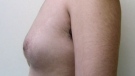 The condition is known as gynecomastia, and it's typically a source of intense embarrassment for some men. .
