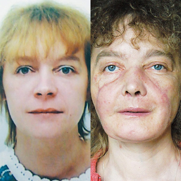 This combination photo shows face transplant patient Isabelle Dinoire in June 2001 (left) and June 2007 (right), 18 months after transplantation, showing her without makeup. (AP / New England Journal of Medicine)