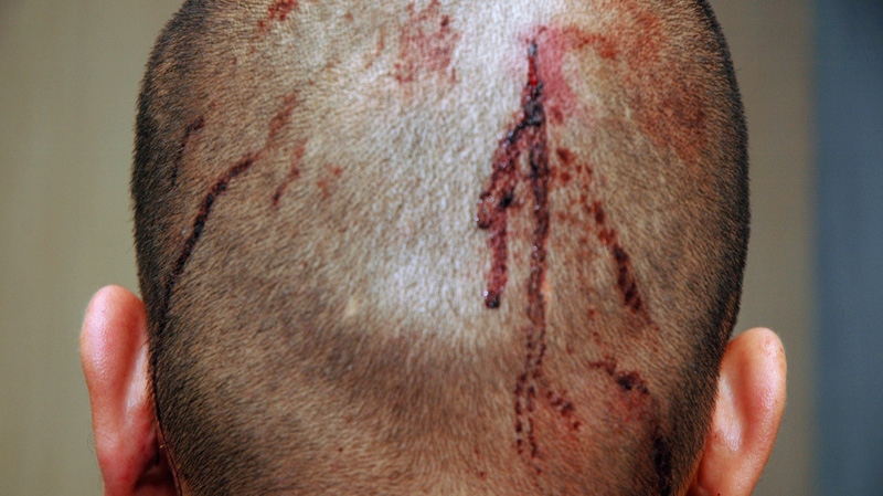 This newly-released photo shows George Zimmerman, the neighborhood watch volunteer who shot Trayvon Martin, with blood on the back of his head on Feb. 27, 2012. (State Attorney's Office)