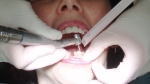 Dentist Works on Teeth 