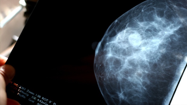 Mammogram Screening 