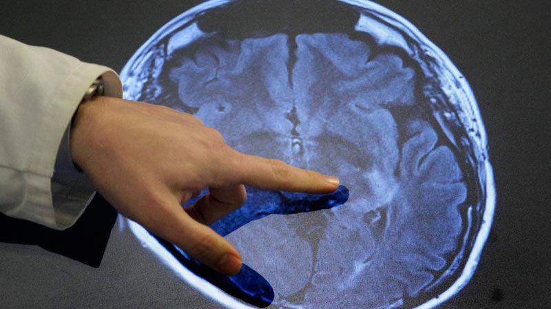 stroke brain scan