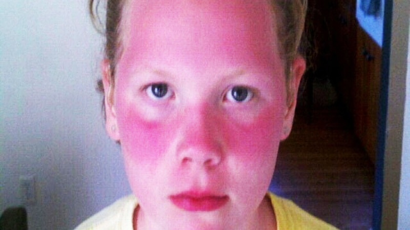 Sunburned girl Violet Michener