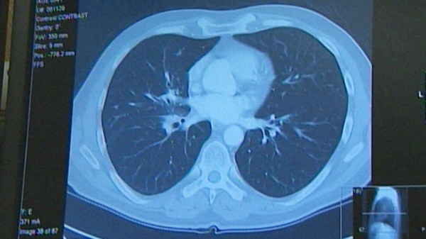 A lung scan to locate cancer is seen in this image taken from video.
