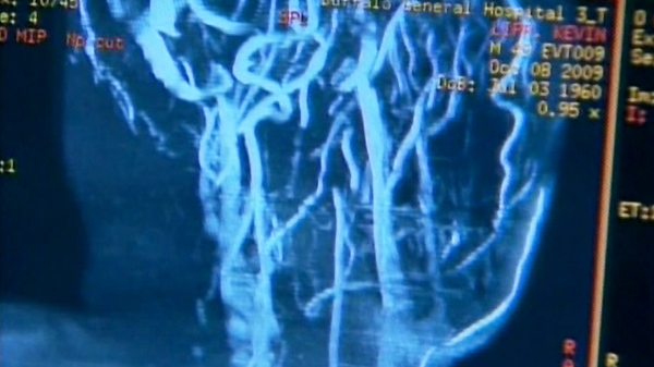 A scan shows the veins in the neck that are involved in the 'Liberation Treatment' for MS.