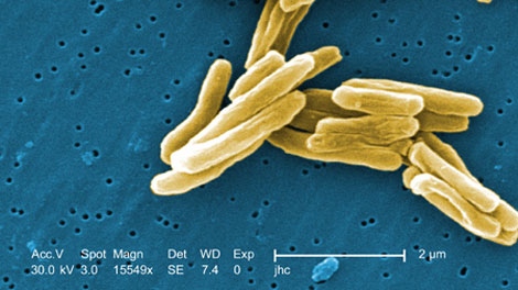 This colorized scanning electron micrograph image shows the Mycobacterium tuberculosis bacteria, the cause of tuberculosis, at a magnification of 15549x. (CDC / Dr. Ray Butler, Janice Carr)
