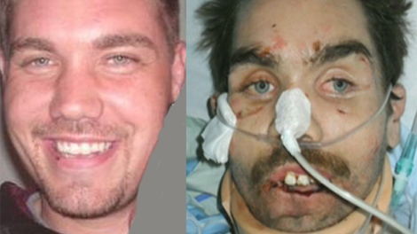Dustin LaFortune is seen here in this composite image of photos taken from Facebook, before and after the alleged torture