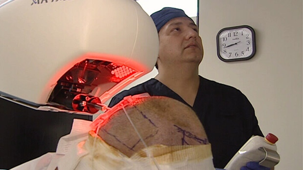 Robotic Hair Transplant