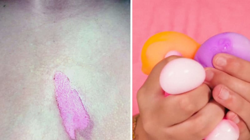 ‘The whole skin came off’: Dangerous implications from social media trend involving microwaved toys