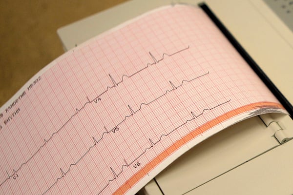 Heart failure rising among younger Canadians, data shows. This cardiologist explains why