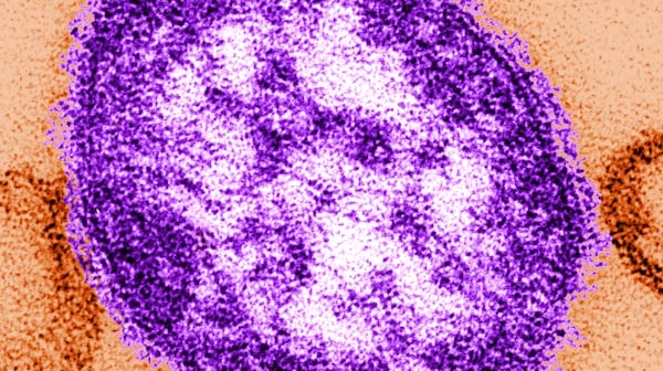 Manitoba measles cases skyrocket