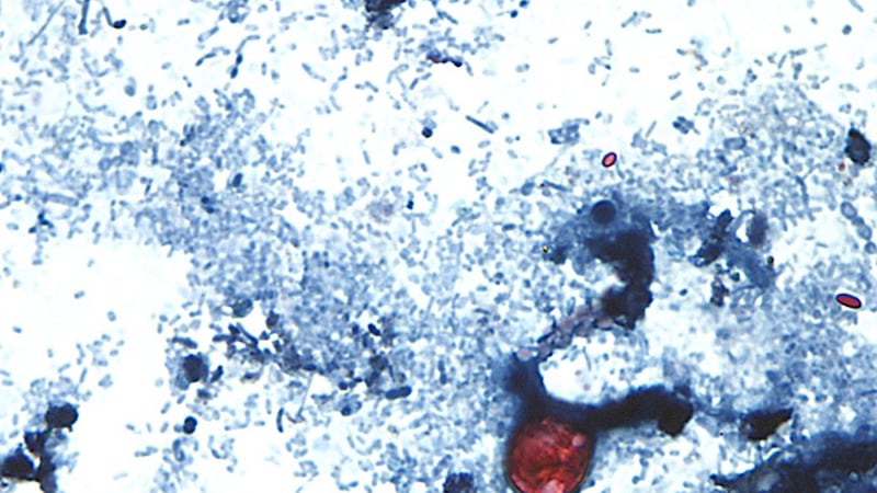 Some U.S. officials blame this salad green for cyclospora outbreak