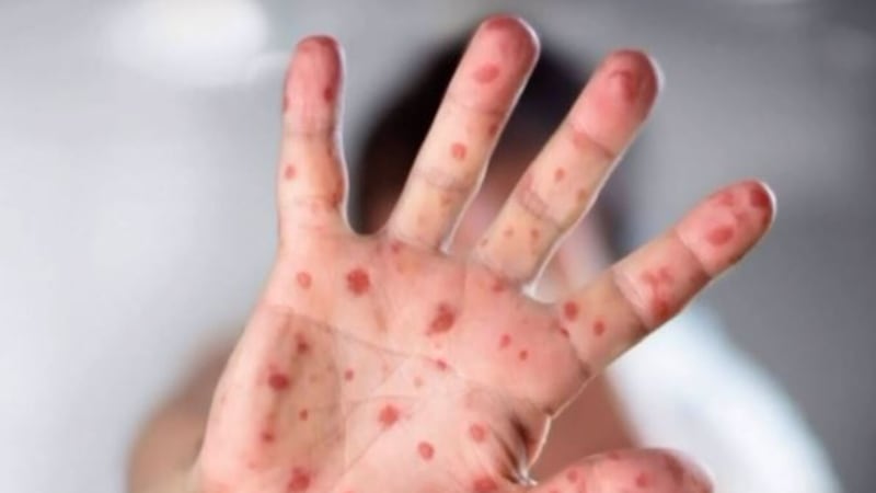 Case of measles detected at Galeries Joliette in Lanaudière