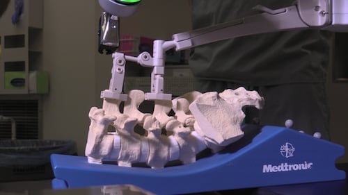 First Ontario pediatric scoliosis surgery using robotic platform: LHSC