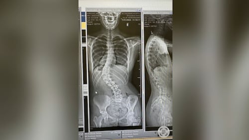‘I want it to be over with’: B.C. teen’s scoliosis surgery pushed to 2027