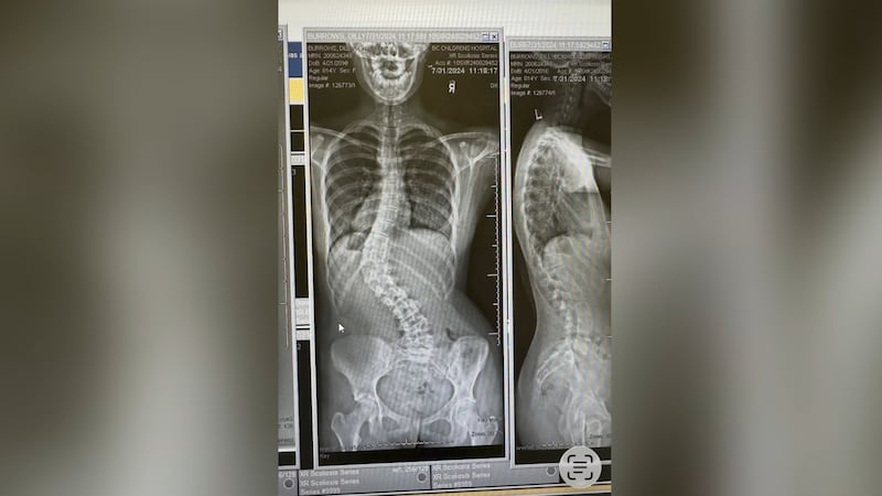 ‘I want it to be over with’: B.C. teen’s scoliosis surgery pushed to 2027