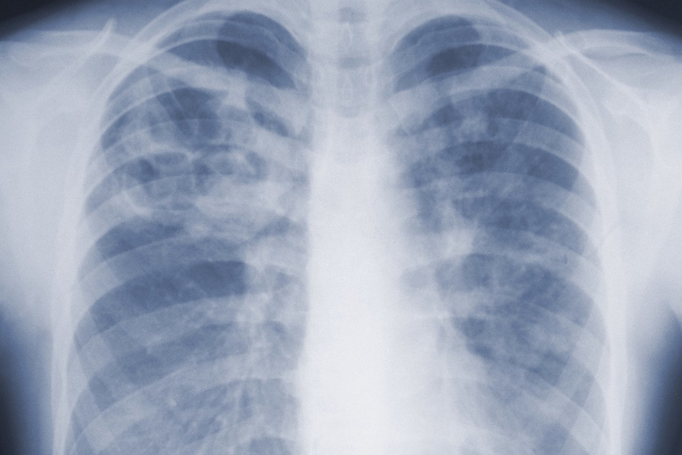 Study suggests the threat of mould-associated illnesses may be underappreciated