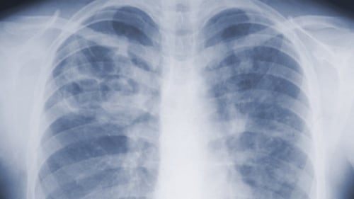 Study suggests the threat of mould-associated illnesses may be underappreciated