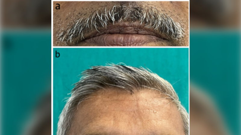 Cancer drug side effect: Grey hair turns black, study shows Cancer drug side effect: Grey hair turns black, study shows
