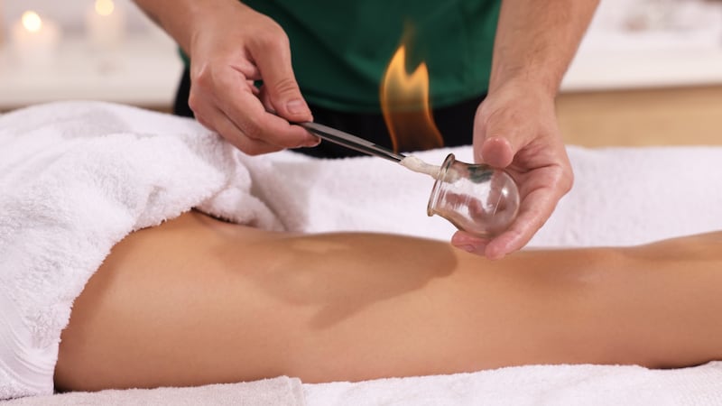 B.C. regulator disciplines cupping practitioner after patient suffers ‘severe blistering’