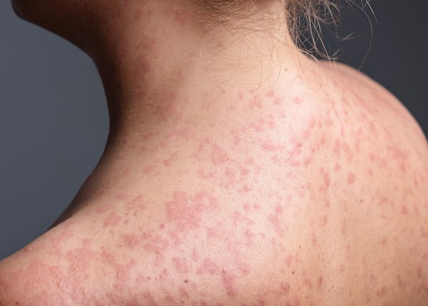 Case of measles detected at Galeries Joliette in Lanaudière
