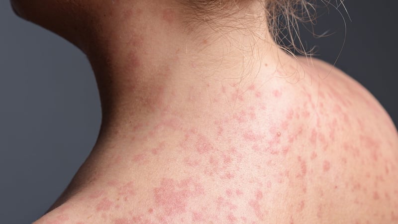 Case of measles detected at Galeries Joliette in Lanaudière