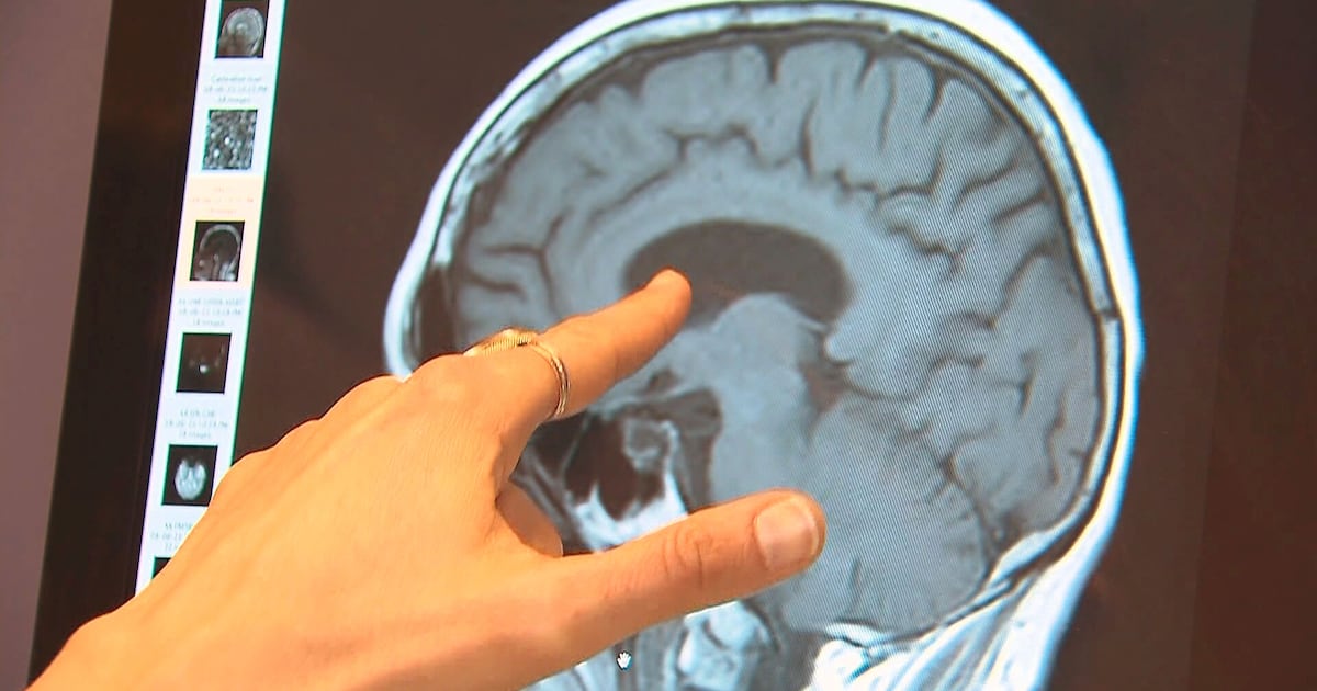 Up to 45% of dementia risk can be prevented, delayed: WHO