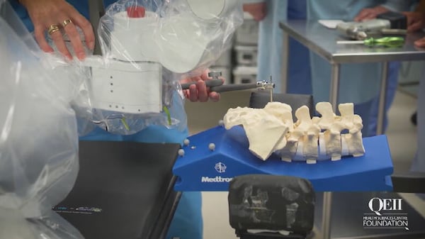 Advanced spinal robot used to help N.S. woman living with severe scoliosis