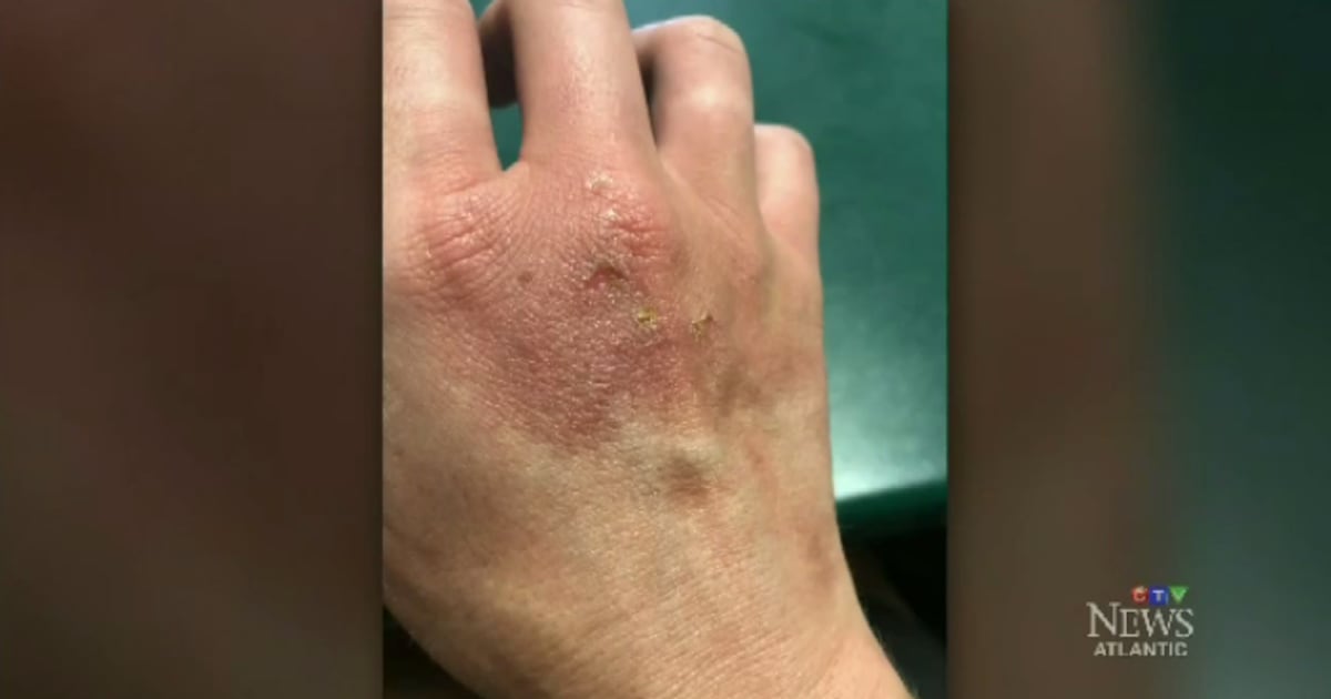 Like your Margaritas? Watch out for 'lime' disease