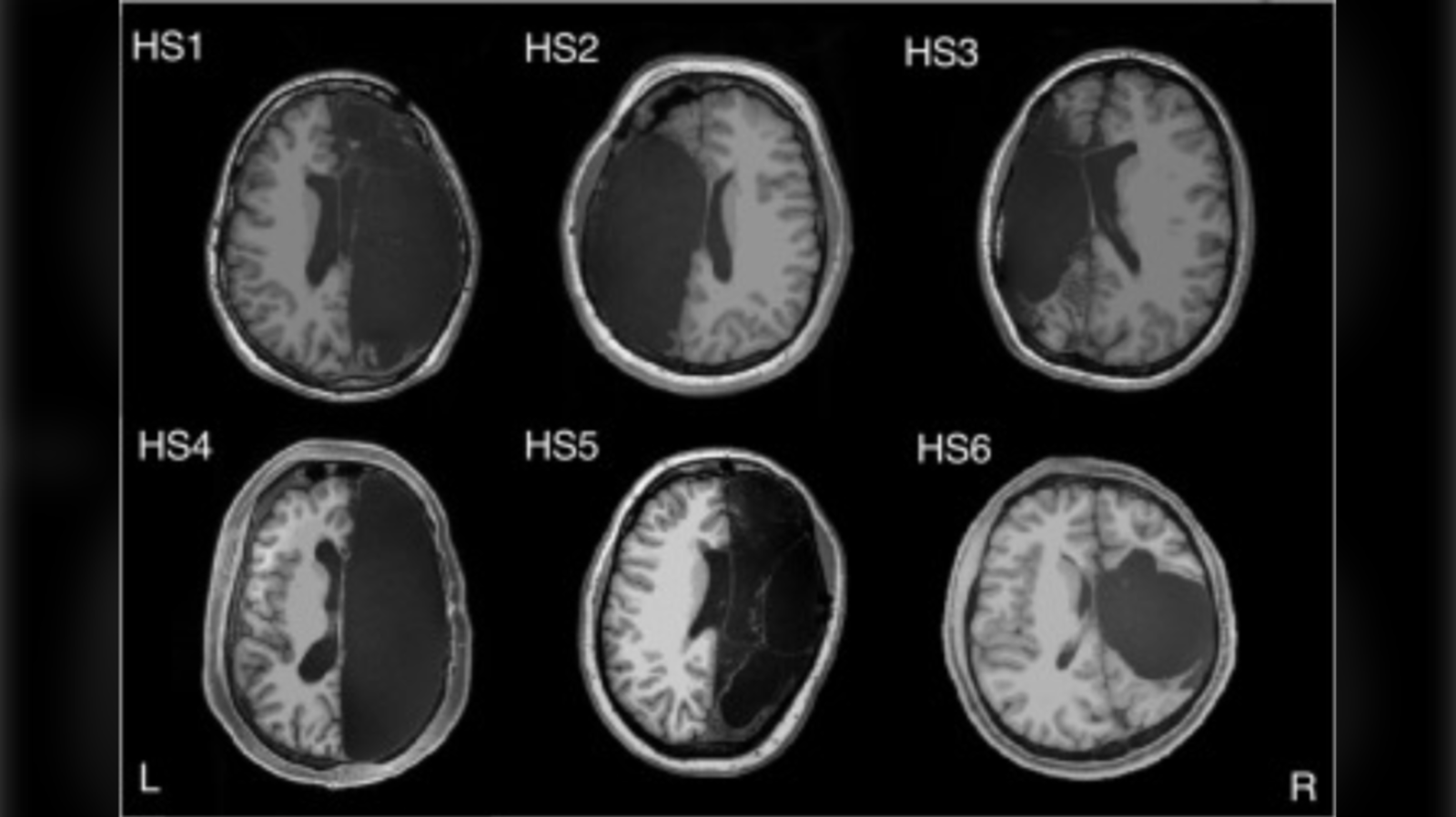 Halfectomy Graph Brain capable of compensating after one half removed: study
