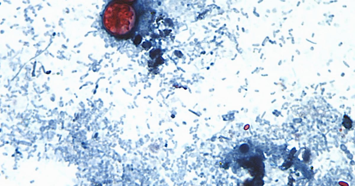 Ảnh chụp qua kính hiển vi do CDC cung cấp cho thấy Cyclospora cayetanensis oocysts trong mẫu phân tươi được chuẩn bị bằng dung dịch formalin và nhuộm safranin. (CDC via AP, File) (Ảnh: Melanie Moser)