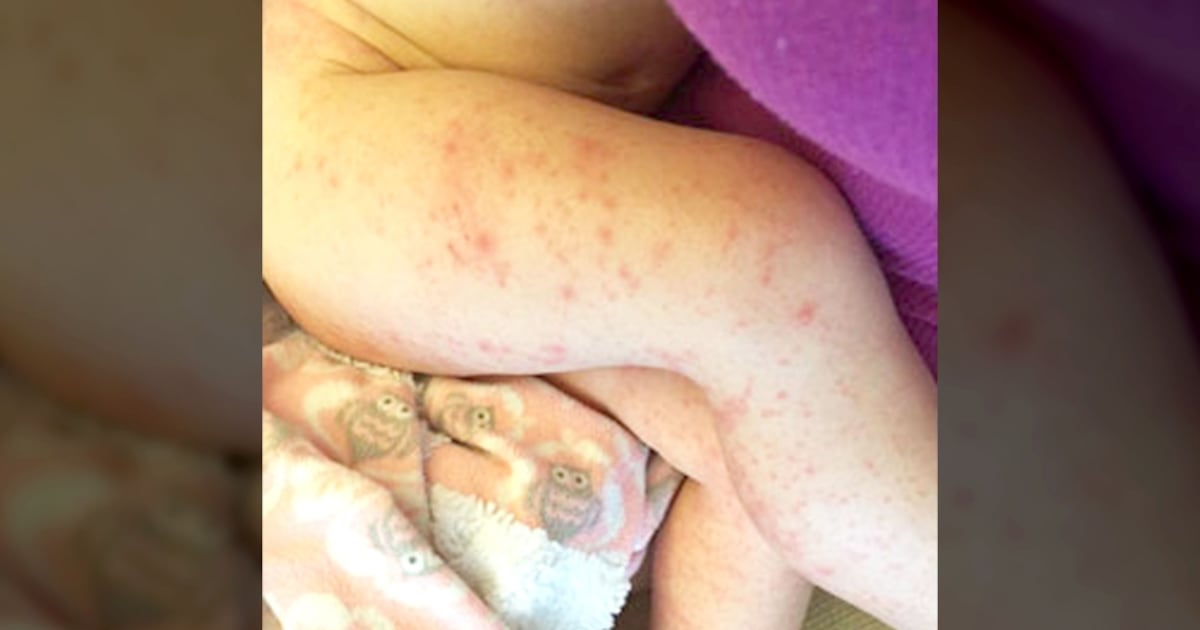 Canadian Rash Canadian children contract infectious rash during vacations in Cancun area