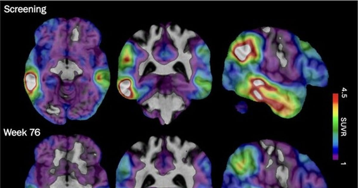 An experimental Alzheimer’s drug approved in U.S. shows some promise as ...